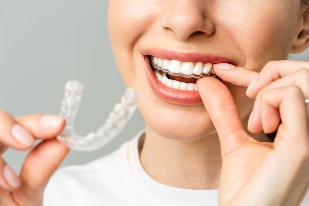 Why Are More Adults Choosing Aligners Over Braces?